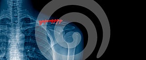 x-ray image and banner design of shoulder in blue tone