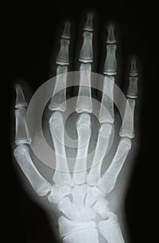 X-ray image of the bones of arm