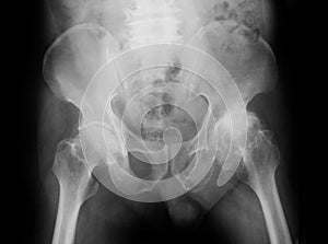 X-ray image of both hip, AP view.