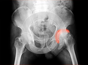 X-ray image of both hip, AP view. photo