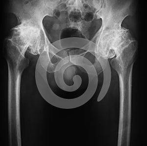 X-ray image of both hip, AP view.