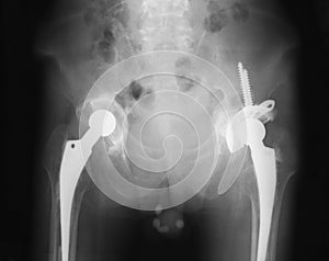 X-ray image of both hip showing hip replacement.