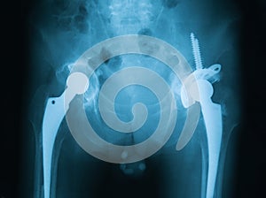 X-ray image of both hip, showing hip replacement