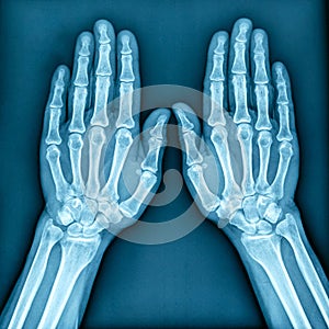 X-Ray Image of both human hands  front view