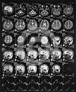 X-ray image of the brain computed tomography photo
