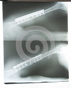 X-ray image of broken arm