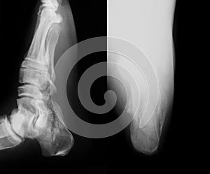 X-ray image of broken calcaneus, AP and axial view. photo