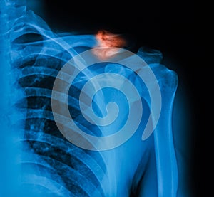 X-ray image of broken clavicle.