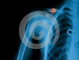 X-ray image of broken clavicle.