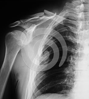 X-ray image of broken clavicle.