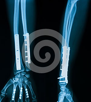 X-ray image of broken forearm.