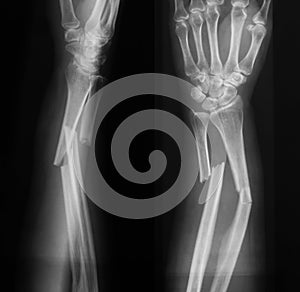 X-ray image of broken forearm, AP and lateral view.