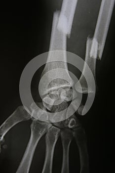 X-ray image of broken forearm, AP and lateral view show fracture