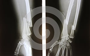 X-ray image of broken forearm, AP and lateral view show fracture