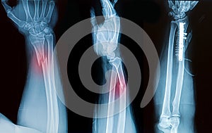 X-ray image of broken forearm bone