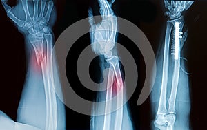 X-ray image of broken forearm bone photo