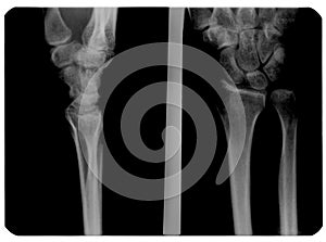 X-ray image of broken hand