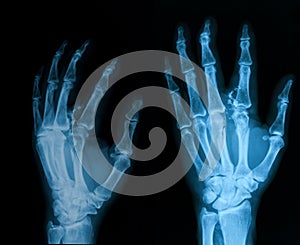 X-ray image of broken hand, AP and oblique view.