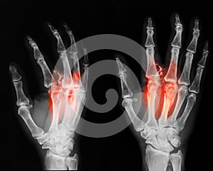 X-ray image of broken hand, AP and oblique view.