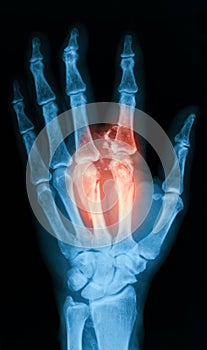 X-ray image of broken hand, AP view.