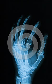 X-ray image of broken hand, oblique view.