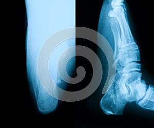 X-ray image of broken heel.