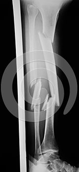 X-ray image of broken lag with plast wood splint