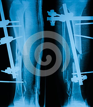 X-ray image of broken leg, AP and lateral view.