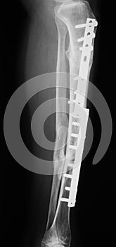 X-ray image of broken leg, AP view.