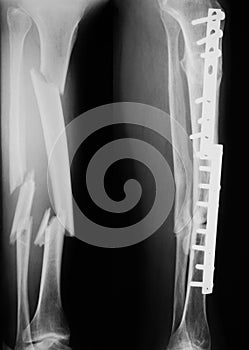 X-ray image of broken leg, lateral view.
