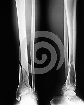 X-ray image of broken leg, Show tibia and fibula fractures. photo