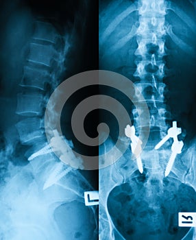 X-ray image of broken LS-spine.