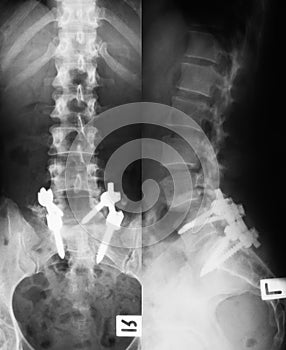 X-ray image of broken LS-spine.