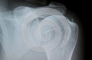 X-Ray image of calcified shoulder Tendinosis calcarea