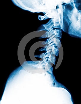 X-Ray image of the cervical spine