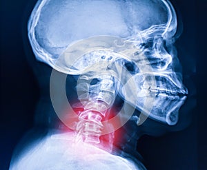 X-ray image of cervical spine, neck x-ray image