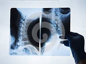 X-ray image of the cervical spine of a woman with osteochondrosis and displacement of the vertebrae