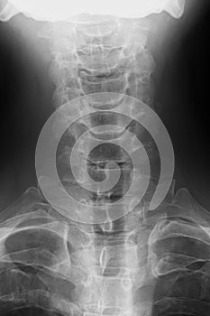 X-ray image of cervical vertebrae, frontal view