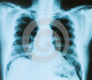 X-ray image of chest bones