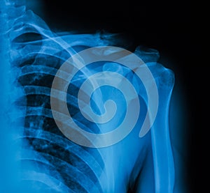 X-ray image of clavicle, AP view