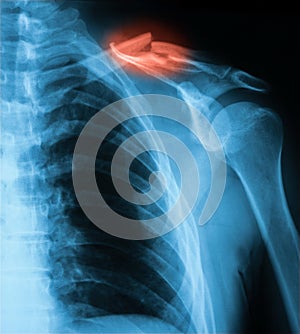 X-ray image of clavicle, AP view.