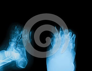 X-ray image of diabetic foot amputation.