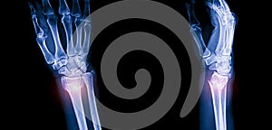 X ray image of distal radius fracture colles fracture.