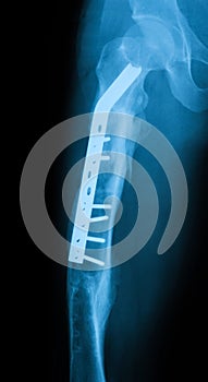 X-ray image of femur,AP view, showing femur fracture wiht commpr