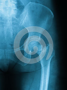 X-ray image of fermeral neck fracture, AP view.