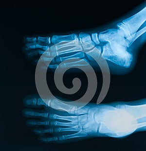 X-Ray image of foot, AP and oblique view.