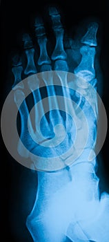 X-ray image of foot, AP view.