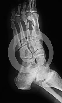 X-ray image of foot, oblique view.