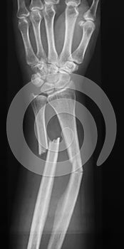 X-ray image of forearm, AP view (Antero-posterior view, show fracture of ulna and radius