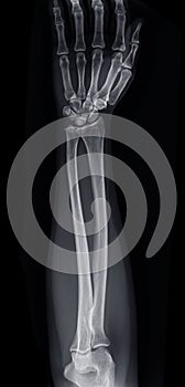 X-ray image of forearm bone